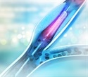 Landmark trial shows drug-eluting balloon as effective option for in-stent restenosis