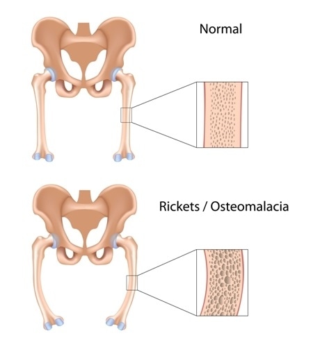 Rickets. Image Credit: Alila Medical Media / Shutterstock
