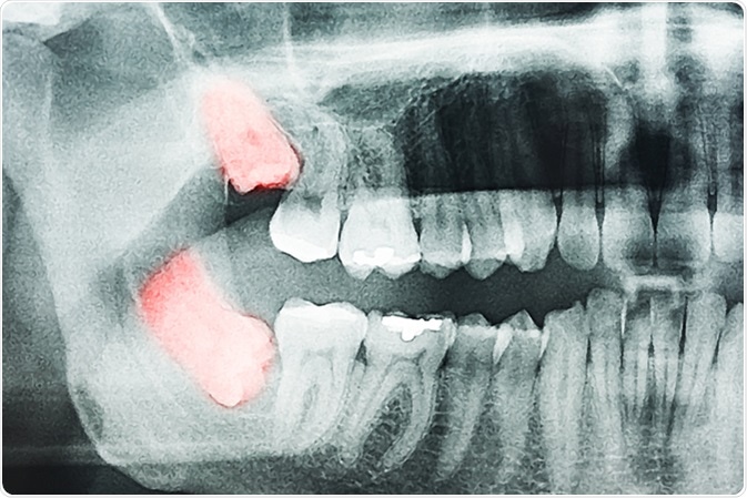 Growing Wisdom Teeth Pain On X-Ray. Image Credit: Radu Bercan / Shutterstock