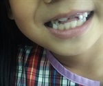 When Should Children Get Their Adult Teeth?