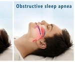 Hypoglossal Nerve Stimulation (HGNS) for Sleep Apnea