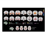 Low-level cannabis use can change the adolescent brain