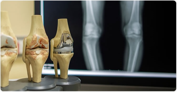 The model of knee joint shown the process of osteoarthritis of knee and total knee replacement surgery. Image Credit: Peter Porrini / Shutterstock