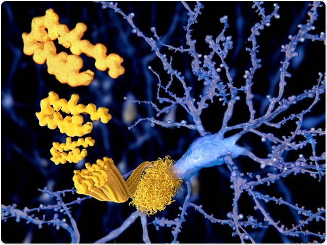 Amyloid plaques growing on a neuron - Illustration Credit: Juan Gaertner / Shutterstock