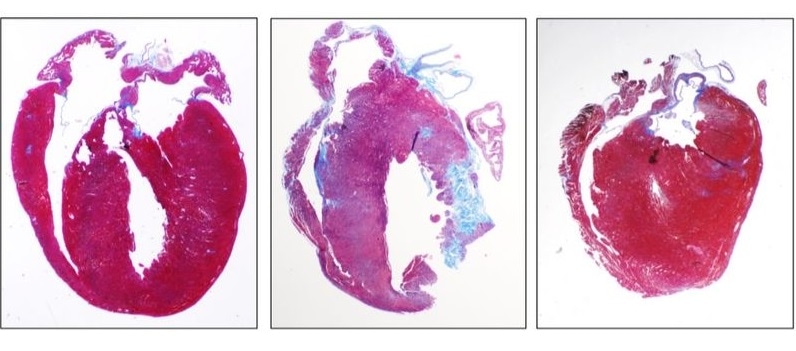 New drug treats inflammation related to inherited heart disease in young athletes