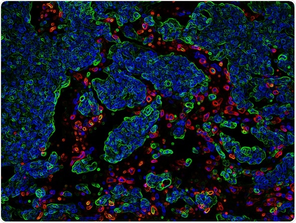 USC study shows how tumor cells circulating in the blood target distant organs