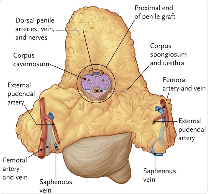 Graft after explantation from the donor. The graft included the right and left external pudendal artery, a segment of the femoral artery, and the saphenous veins on both sides. Dorsal arteries can be seen on the deep, proximal portion of the penile graft. RJ Redett III et al. N Engl J Med 2019;381:1876-1878.