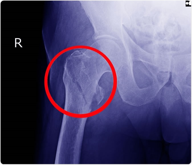 Hip fracture X-ray. Image redit: Richman Photo / Shutterstock