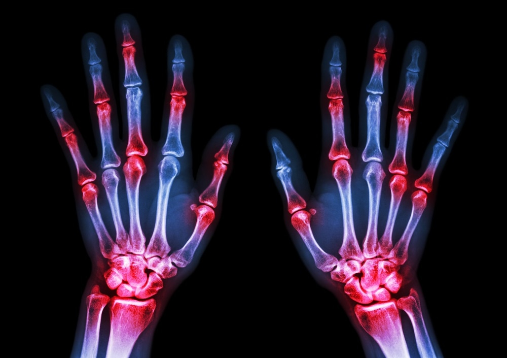 rheumatoid arthritis