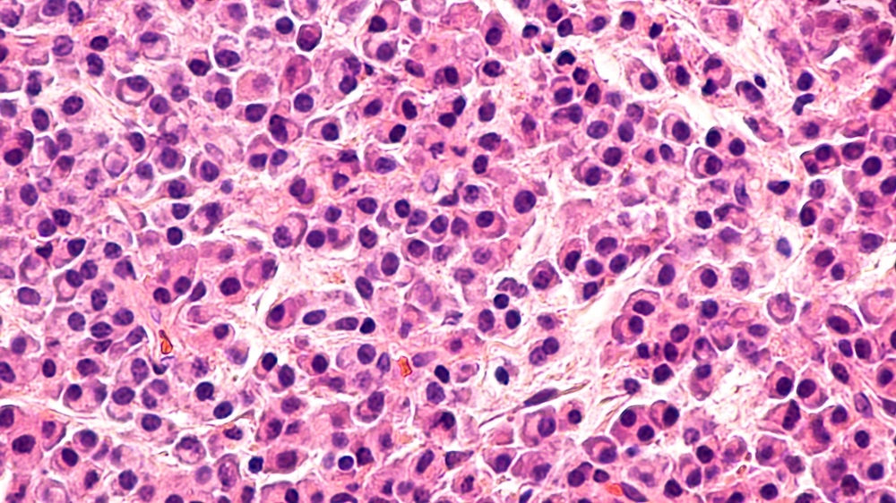 multiple myeloma