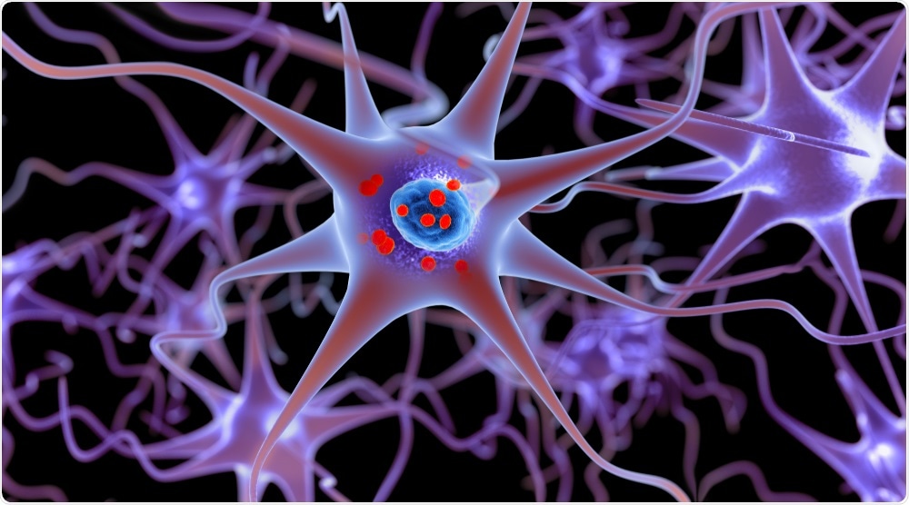 Lewy bodies - illustration