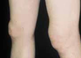 Swollen knees due to Lyme arthritis. Courtesy of Dr. Alan Steere, Massachusetts General Hospital, Boston.