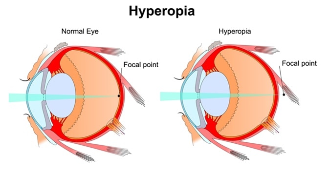 Hyperopia. Image Credit: Slave SPB / Shutterstock