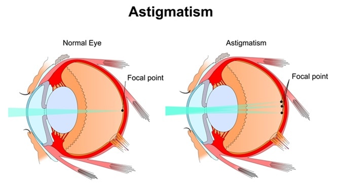 Astigmatism. Image Credit: Slave SPB / Shutterstock