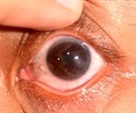 What is Keratitis?