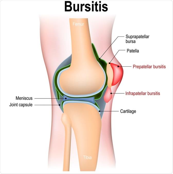 Bursitis - inflammation of bursae (synovial fluid). Prepatellar bursitis (housemaid
