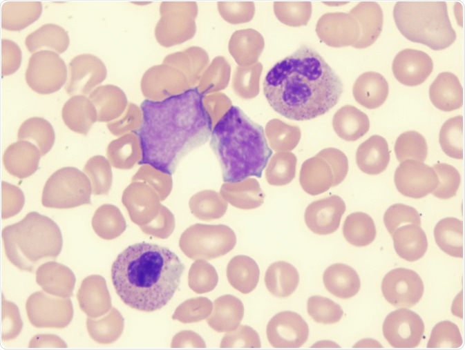 Myelodysplastic syndrome (showing blast and monocyte) - Image Credit: LindseyRN / Shutterstock