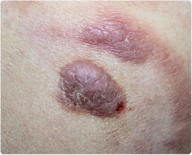 Cutaneous T-cell lymphoma. Image Credit: Dermatology11 / Shutterstock