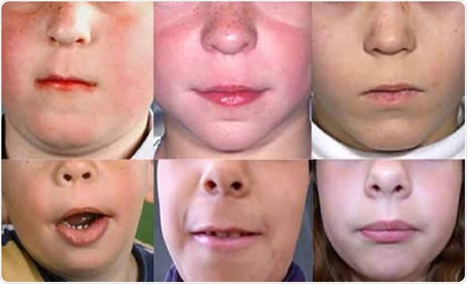 Long philtrum, a symptom of Aarskog-Scott syndrome. Credit: Genetics Home Reference
