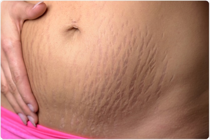 Woman displaying stretch marks on her abdomen after pregnancy caused by tearing of the dermis layer of the skin and showing as red discolorations, close up of her belly - Image Credit: Michaelheim / Shutterstock