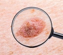 Researchers develop multiethnic model for identifying individuals with skin cancer