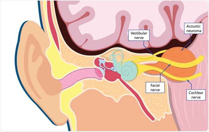 Vestibular Schwannoma (Acoustic Neuroma). Image Credit: Rumruay / Shutterstock