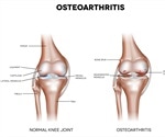 Bursitis and Osteoarthritis Similarities and Differences