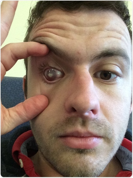 Fight for Sight poll: Brits put their eyesight at risk through unsafe contact lens habits