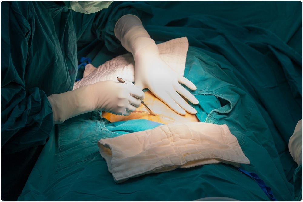 woman having cesarean section