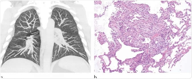 Images show electronic cigarette or vaping product use-associated lung injury in a 32-year-old man with history of vaping who presented with fevers and night sweats for 1 week. (a) Coronal maximum intensity projection image shows diffuse centrilobular nodularity. (b) Histologic sections of his transbronchial cryobiopsy showed distinctive micronodular pattern of airway-centered organizing pneumonia, corresponding to centrilobular nodularity seen at CT. Similar imaging and pathologic findings have been described in patients with smoke synthetic cannabinoids. Image Credit: Radiological Society of North America