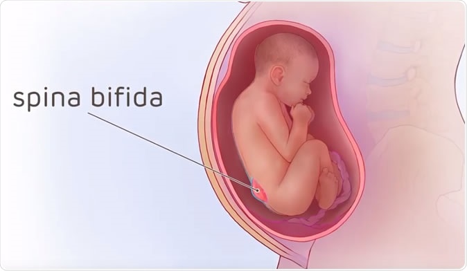 Spina bifida Illustrated - Credit: The Children