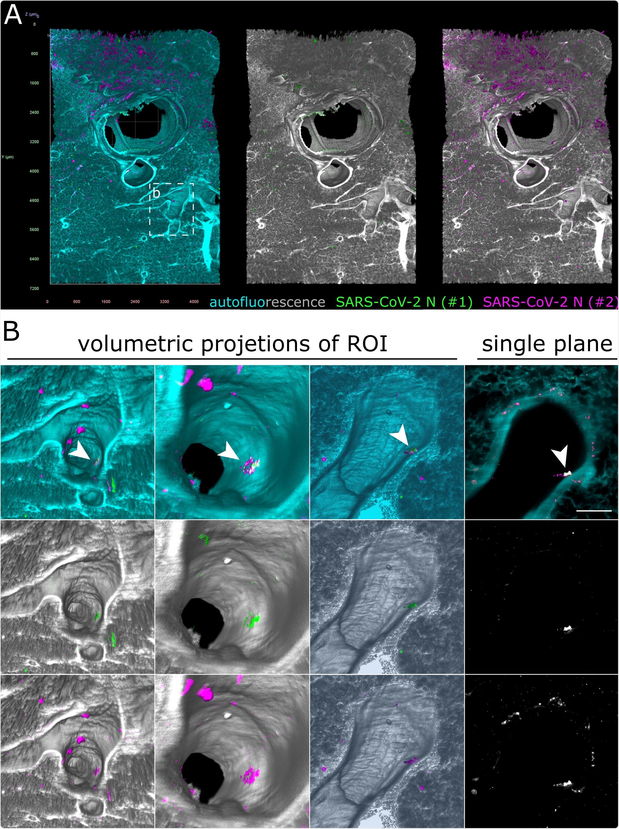 Only debris-associated SARS-CoV-2 antigen was detectable in ferret lung tissue at 4 days post-infection. (A) Volumetric projection of a large lung tissue section. While some background staining is detectable for the monoclonal antibody mix (#2, magenta), no signal overlap with the polyclonal antibody (#1, green) is visible. Cyan/grayscale = autofluorescence. Edge length of grid squares = 800 µm. Total magnification = 1.6x. (B) Alternate viewing angles reveal a spot inside an airway where both signals colocalize (white box in (A)). Contrary to the SARS-CoV-2- associated foci in Figures 2 and 3, the overlapping signal is detected lying on top the epithelial layer, suggesting that it is most likely cell debris inhaled from the URT.