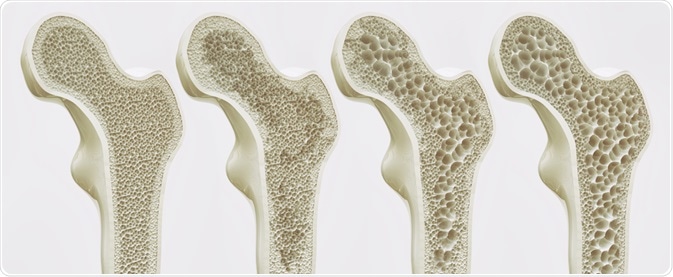 Osteoporosis