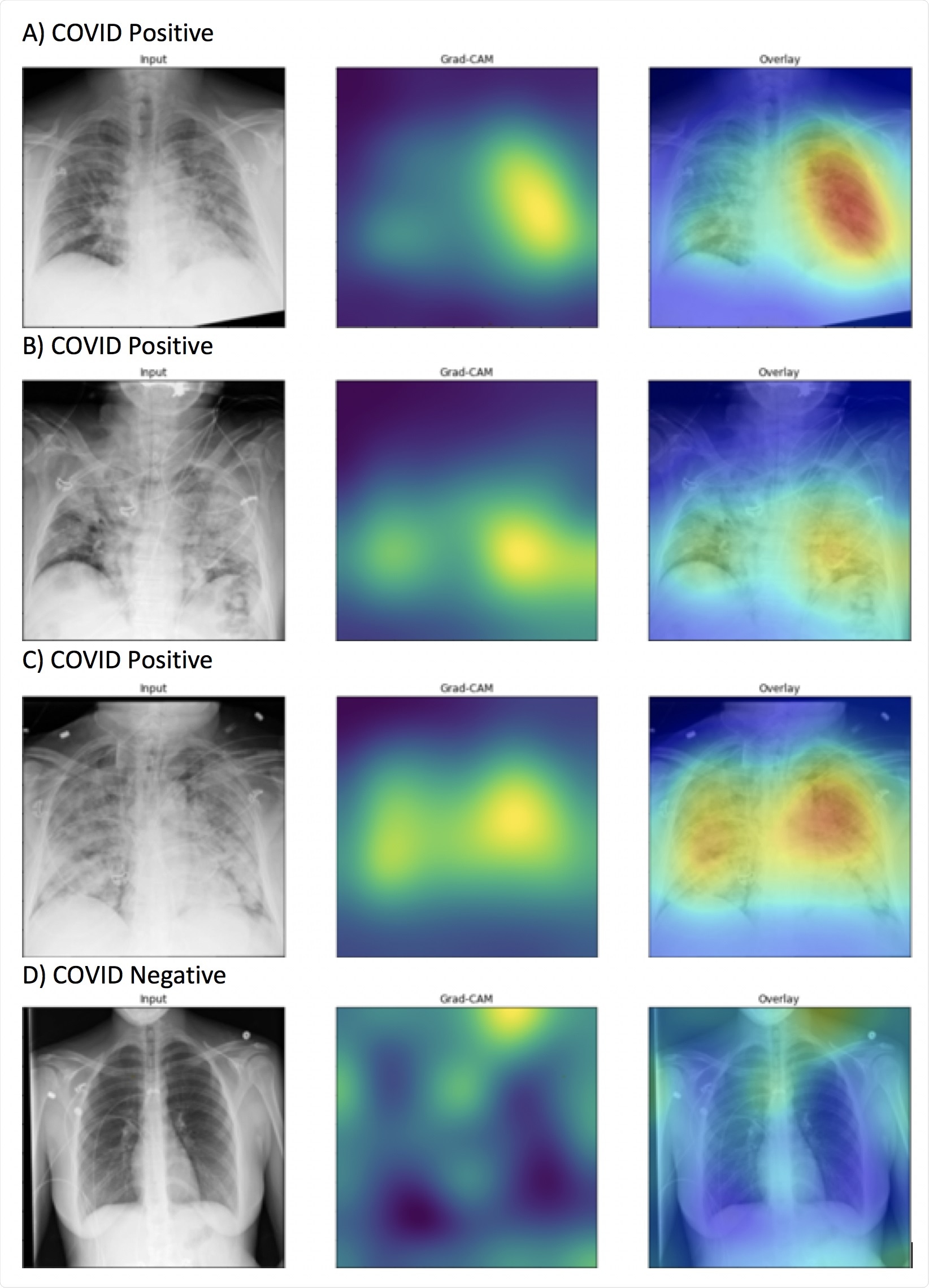 COVID-19 on X-Rays