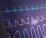 ECG abnormalities can predict COVID-19 mortality