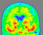 New biomarker of Alzheimer's may lead to enhanced diagnostic methods