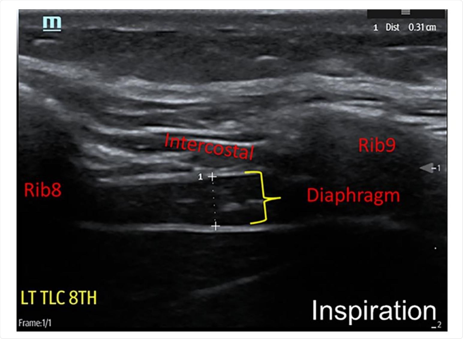 Technique for neuromuscular ultrasound examination of hemi-diaphragm