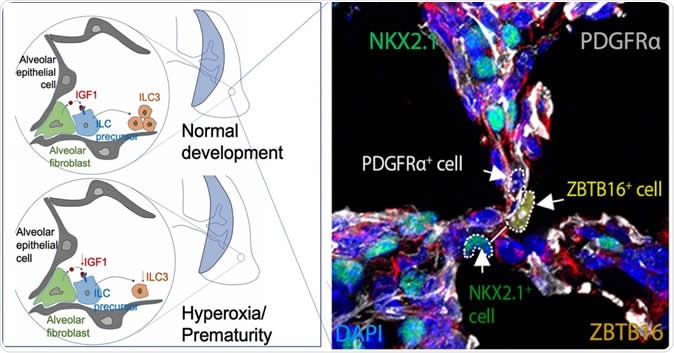 This image from a study in the journal Immunity shows fluoresced cells in the developing perinatal lung of a baby mouse as it forms air sacs called alveolar. The areas highlighted by dotted circles show the molecular components that form Type 3 innate lymphoid cells, which help the lungs develop a durable immune defense against microbial infections. Not shown is a companion comparison image that shows dysfunctional development in the lung of a premature baby mouse. The illustrations at left diagram normal and premature development of air sacs. Image Credit: Cincinnati Children