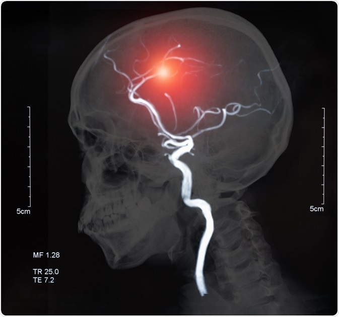 Cerebrovascular Disease