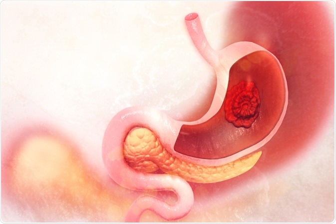 Gastric Cancer