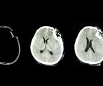 Guidelines for Traumatic Brain Injury in Children