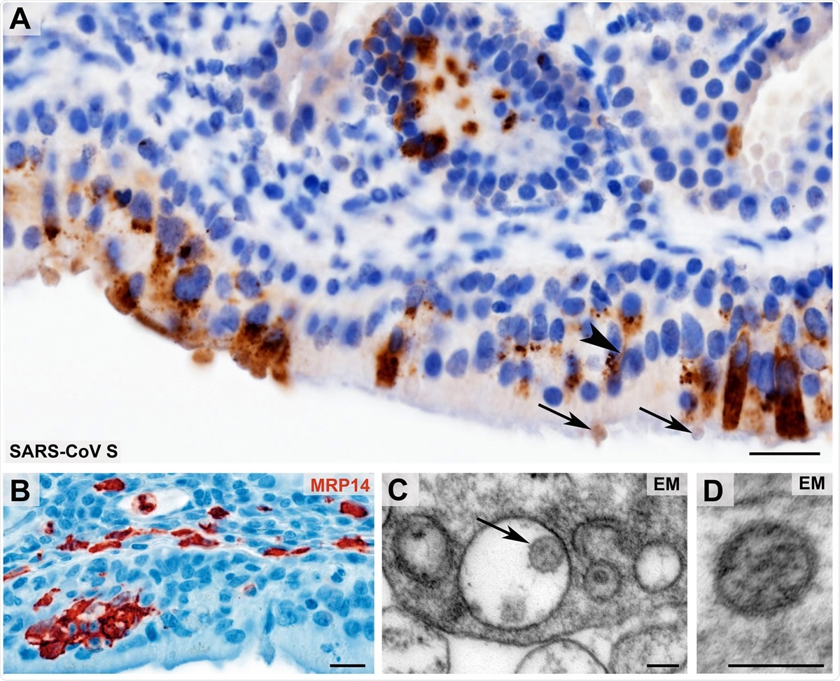 Morphological evidence of SARS-CoV presence and first innate immune cell response within the olfactory mucosa Coronavirus antigen (A, SARS-CoV Spike Protein (SARS-CoV S), brown color) exhibits a cytoplasmic staining with perinuclear accentuation of infected mucosal (epithelial) cells and identifies SARS-CoV383 positive dendrites (arrowhead) and vesicles at the dendrite tips (arrows) of the olfactory receptor neurons. Small clusters of infiltrating, early activated macrophages and granulocytes (MRP14, red color) in the olfactory epithelium upon SARS-CoV-2 infection (B). Ultrastructural images of two different examples of Coronavirus-like particles in the olfactory mucosa (C - D; arrow in C) fulfilling the criteria of size, shape, structural features (membrane, surface structures, electron dense material within the particle, resembling ribonucleoprotein) and localization (C, cytoplasmic localization within a membrane compartment, sometimes with typical attachment on the inner membrane surface as 3shown in this example; D, extracellular). Scale bars: A, B: 20 µm; C, D: 100 nm