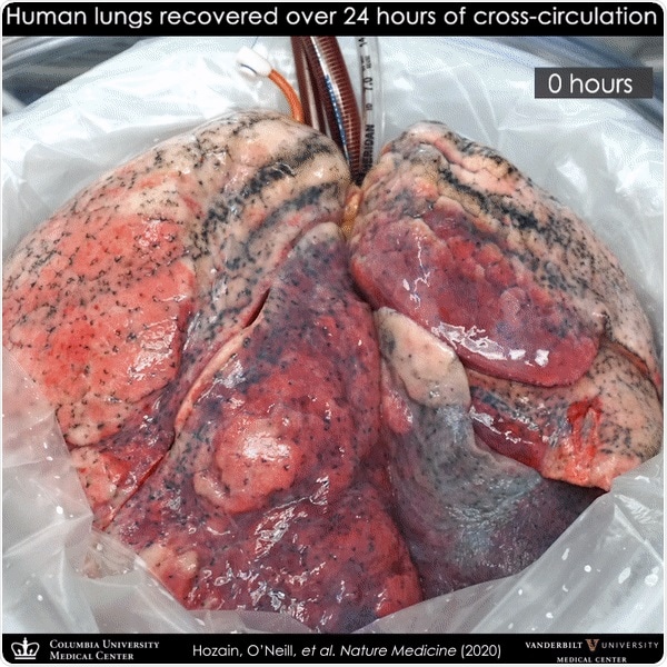 Video showing the sequence of lung recovery on cross-circulation system.