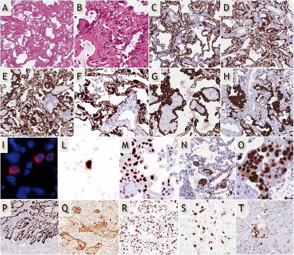 Early-phase COVID-19 pneumonia. H&E (A,B): Parenchymal structure is variably altered by AECII hyperplasia, vascular enlargement and interstitial thickening. CK7 (G-H): AECII form variable small nodules, aggregates and pseudo-papillary sprouts. Grade-1 (C,D) and -2 (E-H) Covid-19 histological patterns were defined by the extent of AEC II hyperplasia. In situ demonstration of AECII infected by SARS-CoV-2 (I): cytoplasmic (red) signals are evidenced in scattered cells recognized as AECII by morphology and location. In situ analysis of IL-6 mRNA expression (L): strong signal is evidenced in scattered AECII. Ph-STAT3 immunohistochemistry (M): strong signal demonstrated in most AECII. TBB3 immunohistochemistry (N): strong signal in AECII. Interstitial dilated spaces are negative. Ki67 immunohistochemistry (O): elevated (>50%) proliferation in AECII. Late-phase Covid-19 pneumonia. CK7 (P): typical DAD-presentation with homogeneous “lepidic” alveolar covering by AECII. TBB3 (Q) strong reaction in myofibroblast-rich areas. phSTAT3 (R): diffuse nuclear expression in AECII, macrophages and stromal cells. IL-6 mRNA in-situ (S): increased numbers of positive cells. PD-L1 (T): negative results in most blood vessels.