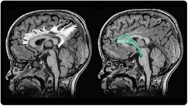 Prenatal depression influences child