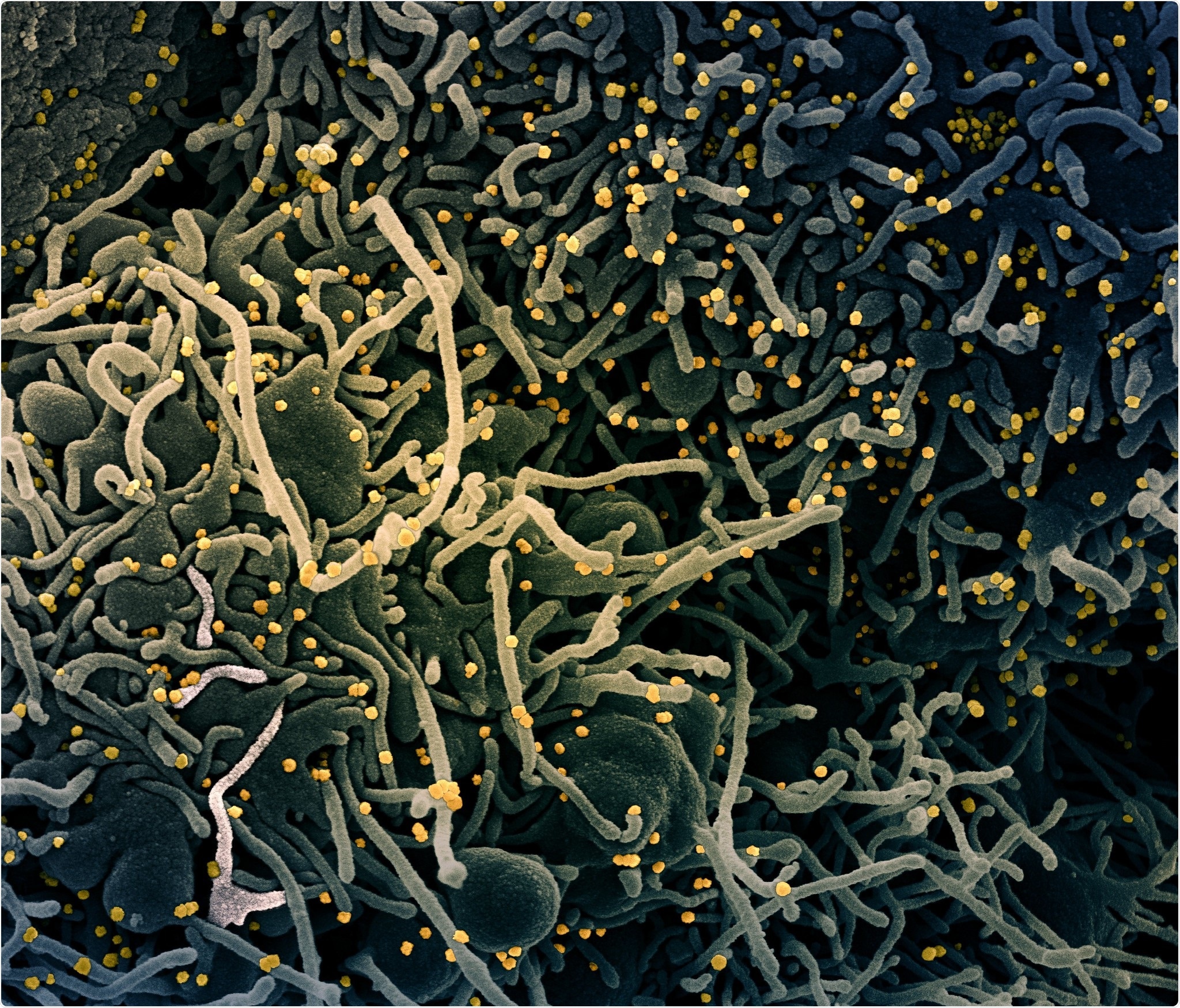 Colorized scanning electron micrograph of a VERO E6 cell (blue-green) exhibiting elongated cell projections and signs of apoptosis, after infection with SARS-COV-2 virus particles (yellow), which were isolated from a patient sample. Image captured at the NIAID Integrated Research Facility (IRF) in Fort Detrick, Maryland. Credit: NIAID