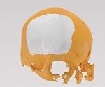 Osteopore announces success of its 3D-printed PCL bone implant in cranioplasty procedure