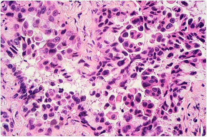 adenocarcinoma