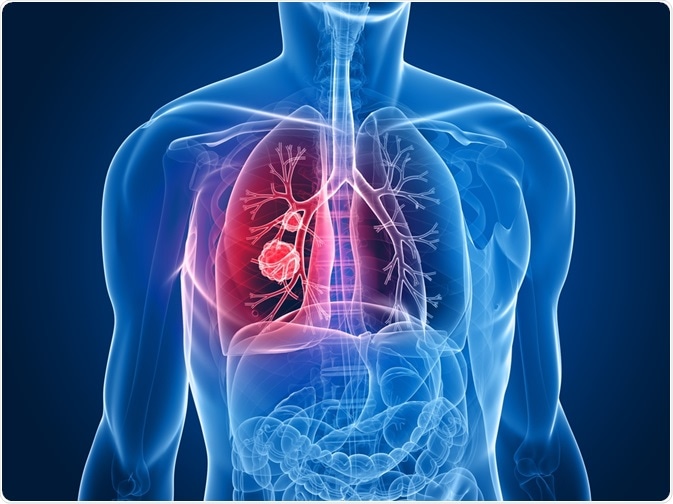 Lung Cancer