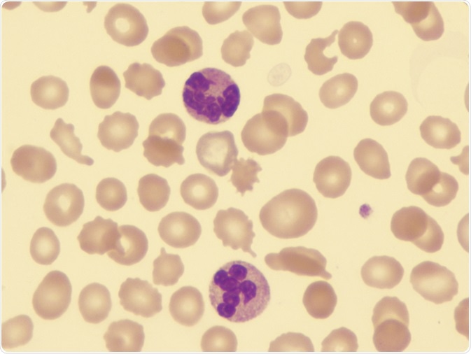 Myelodysplastic syndromes